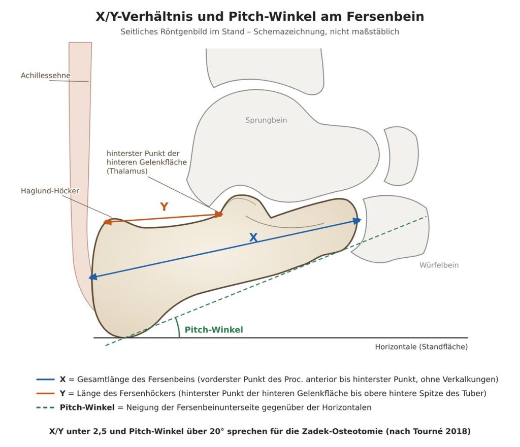 zadek-osteotomie-xy-verhaeltnis-pitch-winkel | ORTHO | PEDE Zentrum für Fuß und Sprunggelenk Schemazeichnung: Messung von X/Y-Verhältnis und Pitch-Winkel am Fersenbein im seitlichen Röntgenbild